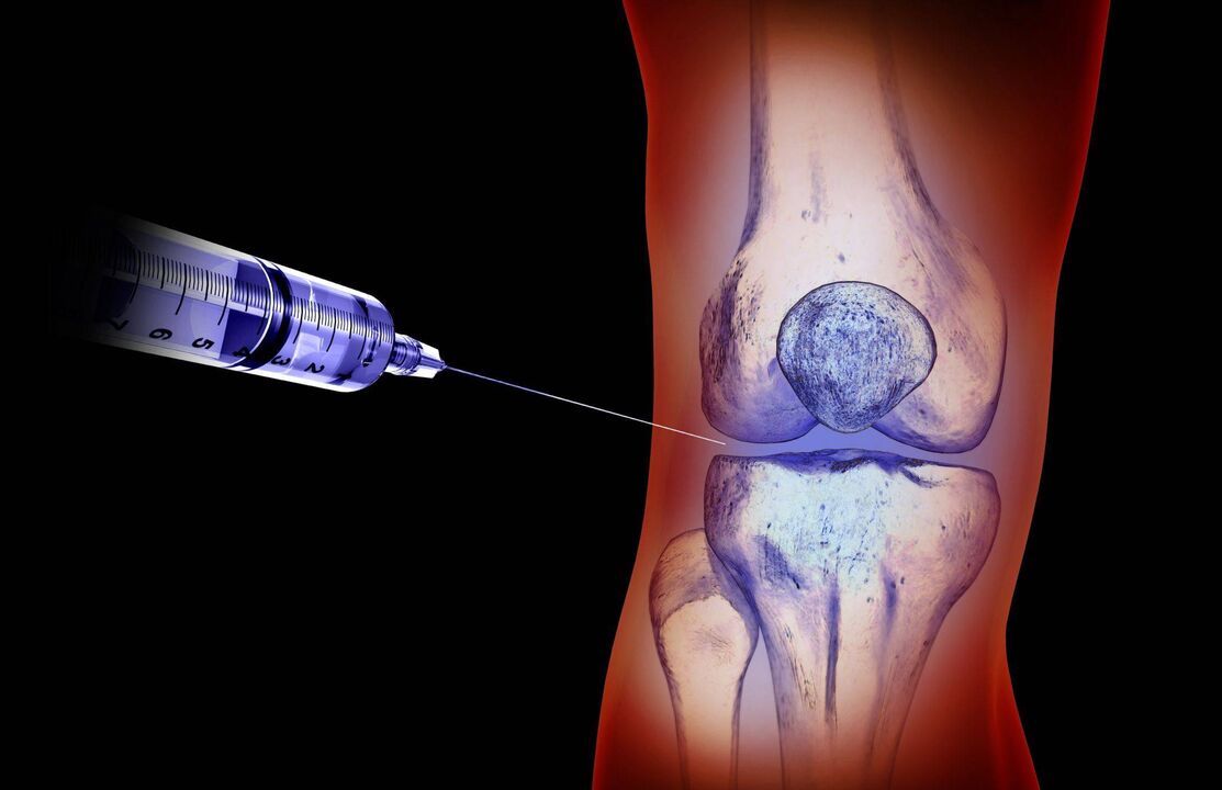 inyecciones intraarticulares para el tratamiento de la artrosis