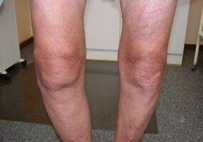 Cómo tratar la articulación de la articulación de la rodilla