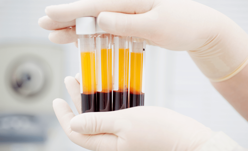 Plasma rico en plaquetas para el tratamiento con PRP de la artrosis